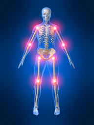 bromelaine arthrite